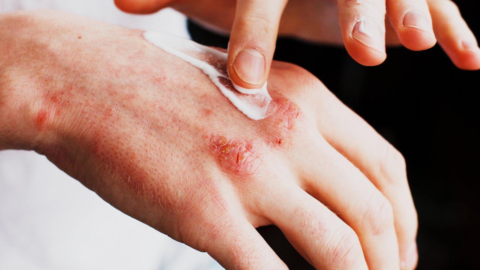 Skin Type - Sensitive